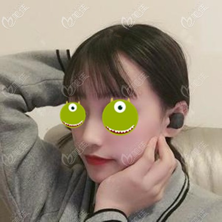 二次修復(fù)鼻子時找范浚澤醫(yī)生把膨體換成了生科3段硅膠假體