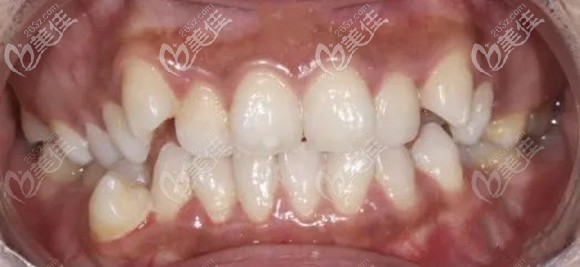 我是牙齒咬合錯(cuò)亂 我是牙齒咬合錯(cuò)亂