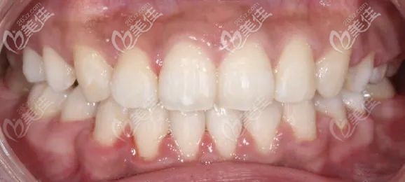 牙齒咬合錯(cuò)位,在口腔戴自鎖鋼牙套的矯正經(jīng)歷