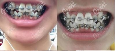 長沙德韓口腔金屬鋼牙套矯正案例 長沙德韓口腔金屬鋼牙套矯正案例