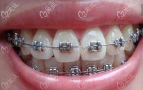 金屬自鎖鋼牙套 金屬自鎖鋼牙套