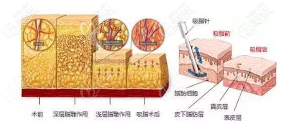 李弋院長(zhǎng)的維密脂雕術(shù)優(yōu)勢(shì) 李弋院長(zhǎng)的維密脂雕術(shù)優(yōu)勢(shì)