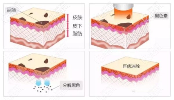 李晶醫(yī)生做激光祛痣的技術(shù)優(yōu)勢 李晶醫(yī)生做激光祛痣的技術(shù)優(yōu)勢