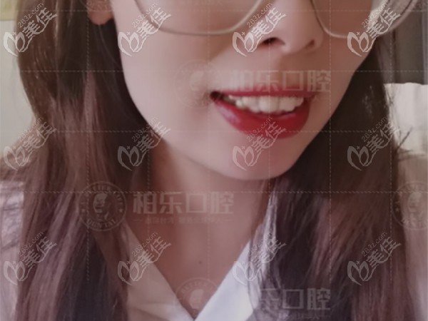 戴隱適美igo極速版隱形牙套成功解決了我前牙深覆頜的問題，效果給滿分