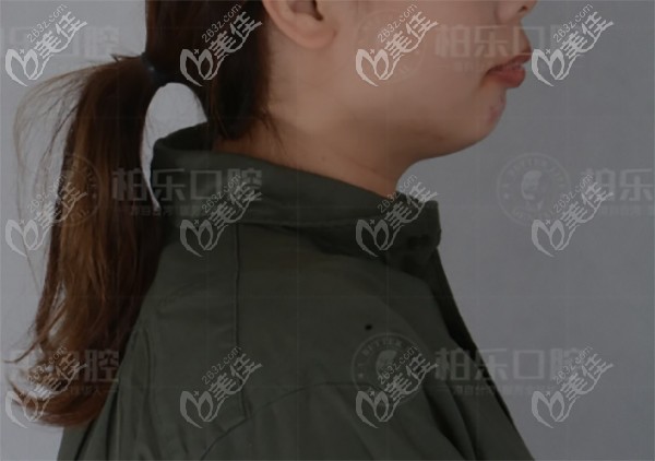 南寧柏樂沒做深覆合矯正之前的牙齒 南寧柏樂沒做深覆合矯正之前的牙齒