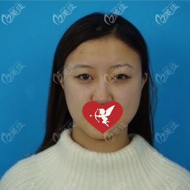 做埋線雙眼皮術(shù)前照 做埋線雙眼皮術(shù)前照