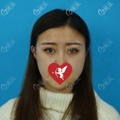 埋線雙眼皮術(shù)后10天恢復(fù)效果照 埋線雙眼皮術(shù)后10天恢復(fù)效果照