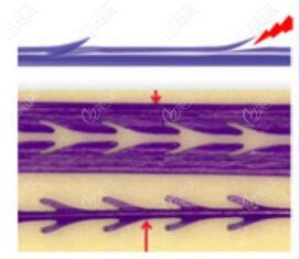美國強生魚骨線介紹