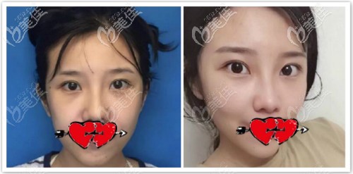 美國強生魚骨線埋線提升一年效果對比圖