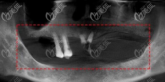 牙槽骨吸收 牙槽骨吸收