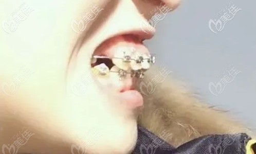 國(guó)產(chǎn)金屬矯正第10個(gè)月