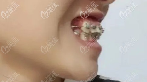 時(shí)隔兩個(gè)月變化也蠻大的