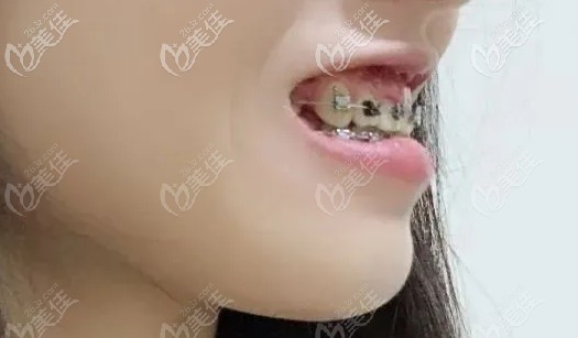 上下牙還得繼續(xù)收縫