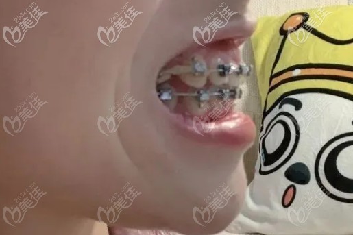 拉虎牙，繼續(xù)收縫