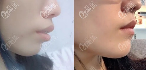 2顆門牙做了烤瓷牙后箍牙成功:我用國產(chǎn)自鎖托槽矯正了骨性齙牙