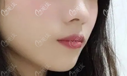 嘴巴突出的部分已經(jīng)平了