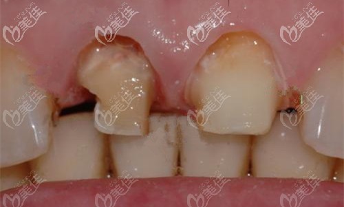 門(mén)牙磨小以后做的烤瓷冠