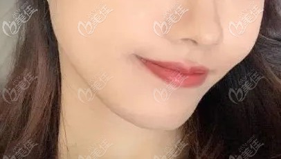 閉嘴也看不出來(lái)牙套的存在