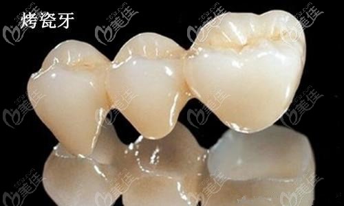 烤瓷牙的出現(xiàn)哪些癥狀表示該換了呢？