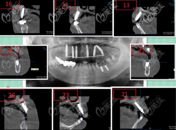 上半口ALL-ON-6即刻負(fù)重種植牙 上半口ALL-ON-6即刻負(fù)重種植牙