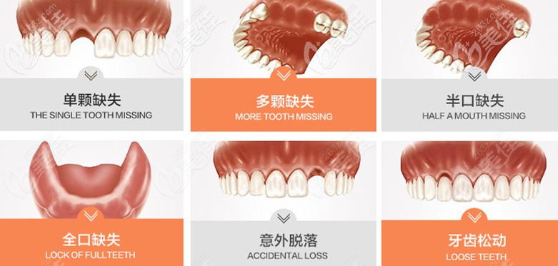 哪些人需要做種植牙