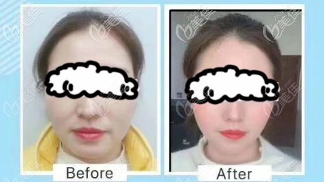 做艾美緹st筋膜再植提升全臉半年效果對比圖