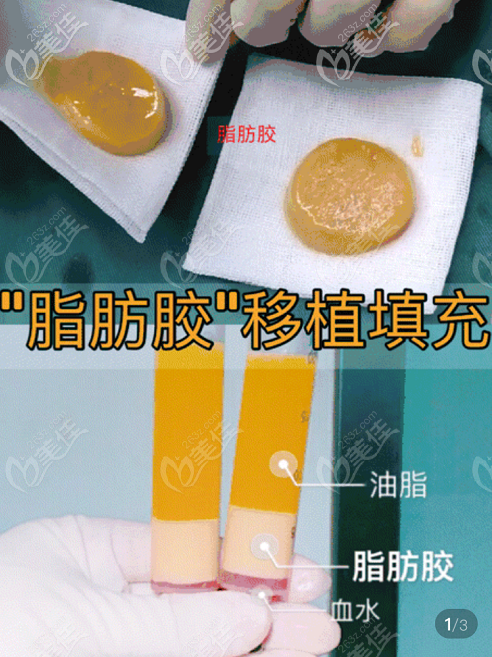 脂肪膠填充法令紋成活率高維持時(shí)間長(zhǎng)