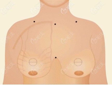 抽脂縮胸會把胸變下垂嗎 抽脂縮胸會把胸變下垂嗎