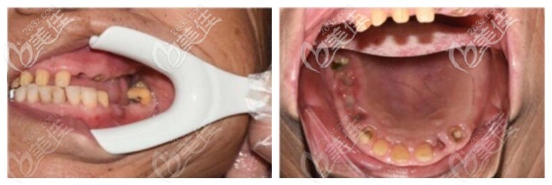 三亞鼎點(diǎn)口腔上半口缺失案例 三亞鼎點(diǎn)口腔上半口缺失案例