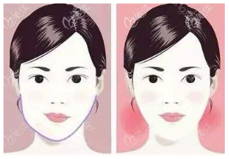 歪臉矯正手術(shù)價格在35000-55000元左右