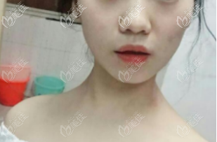 下巴后縮和凸嘴的照片 下巴后縮和凸嘴的照片