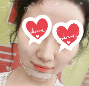 剛打完玻尿酸的下巴 剛打完玻尿酸的下巴