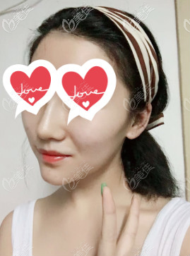 注射完玻尿酸填充下巴后完全恢復(fù)好的樣子 注射完玻尿酸填充下巴后完全恢復(fù)好的樣子