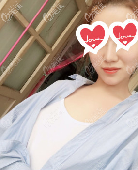 嘴凸下巴后縮的我打完玻尿酸墊下巴后感覺嘴不凸了