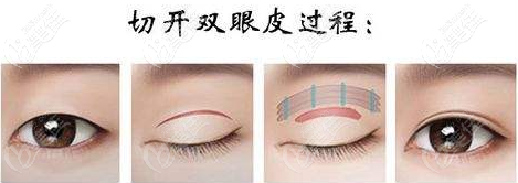 切開雙眼皮手術(shù)過程圖 切開雙眼皮手術(shù)過程圖