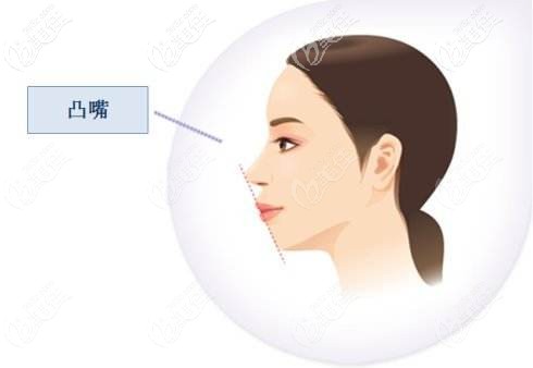 深覆合突嘴戴牙套的效果好嗎 深覆合突嘴戴牙套的效果好嗎