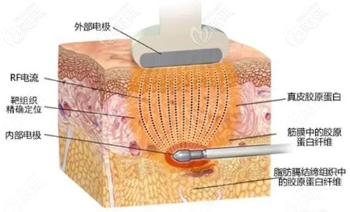 寶麗太吸脂原理圖 寶麗太吸脂原理圖