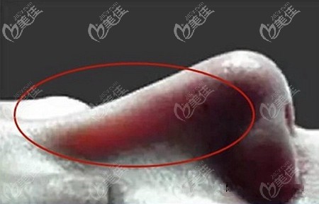 注射喬雅登5號隆鼻后透光的原因