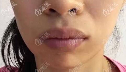 深覆合導(dǎo)致齙牙矯正前的照片 深覆合導(dǎo)致齙牙矯正前的照片