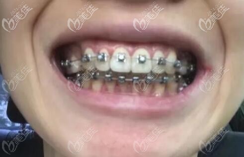 在廣州華醫(yī)口腔戴的金屬自鎖牙套 在廣州華醫(yī)口腔戴的金屬自鎖牙套