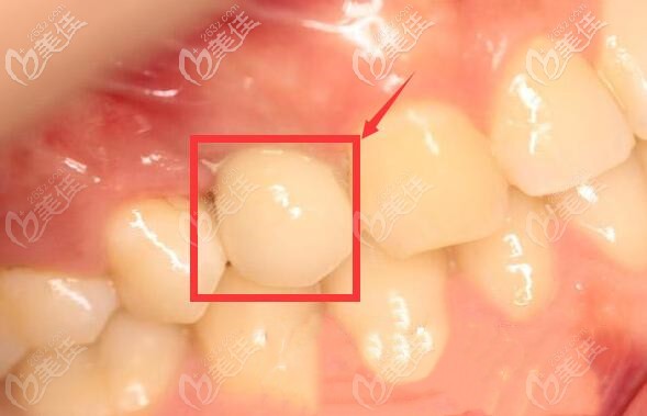 解答:天津河西區(qū)雅爾美口腔做單顆韓系種植牙需要多長時間