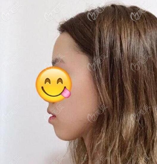 齙牙矯正前從側臉上看下巴后縮特別厲害 齙牙矯正前從側臉上看下巴后縮特別厲害