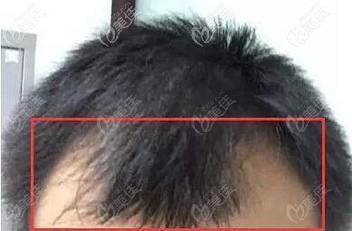 男士m型發(fā)際線脫發(fā)