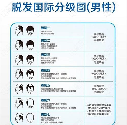 男士脫發(fā)等級分級圖