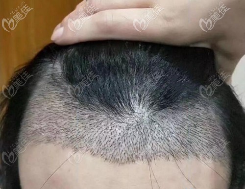 前額發(fā)際線植發(fā)效果圖片