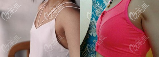 脂肪豐胸一個(gè)月后的樣子 脂肪豐胸一個(gè)月后的樣子