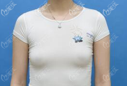 第二次脂肪豐胸的樣子 第二次脂肪豐胸的樣子