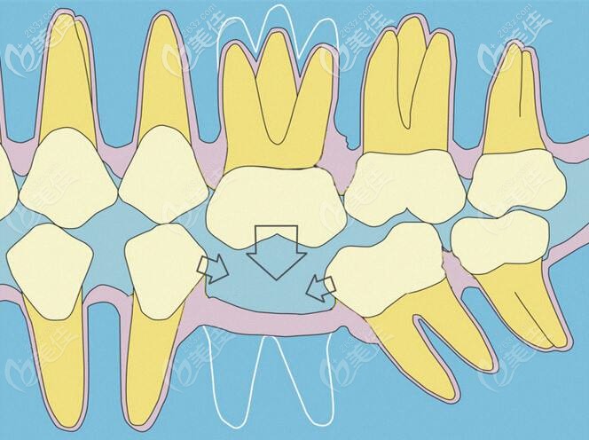 單顆牙齒缺失的危害