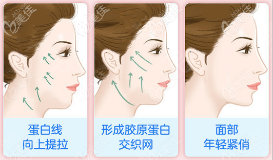 深圳鵬程醫(yī)院周毅濤醫(yī)生埋線提升效果 深圳鵬程醫(yī)院周毅濤醫(yī)生埋線提升效果