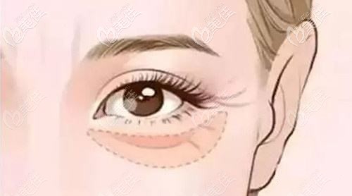 臥蠶過大會(huì)容易形成眼袋 臥蠶過大會(huì)容易形成眼袋